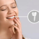 How Long Do Dental Implants Really Last? A Complete Guide