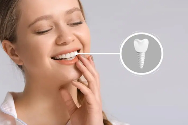 How Long Do Dental Implants Really Last? A Complete Guide