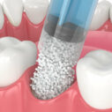 Bone Grafting 101: What It Is and Why It’s Necessary for Dental Implants