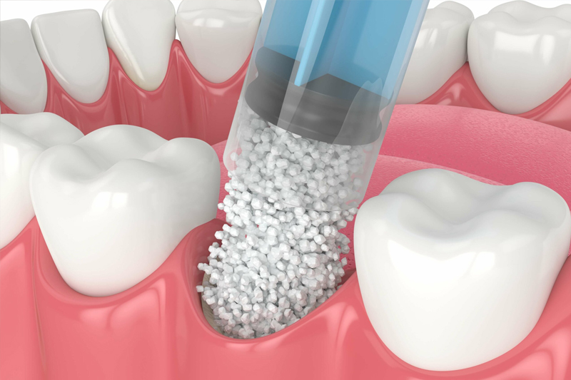 Bone Grafting 101: What It Is and Why It’s Necessary for Dental Implants