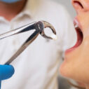 Wisdom Teeth Removal: Is It Necessary for Everyone? Here’s What You Should Know