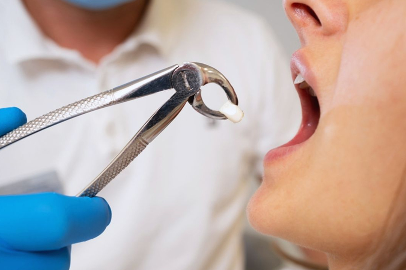 Wisdom Teeth Removal: Is It Necessary for Everyone? Here’s What You Should Know